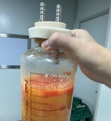 宝鸡水动力吸脂手术要做多久？